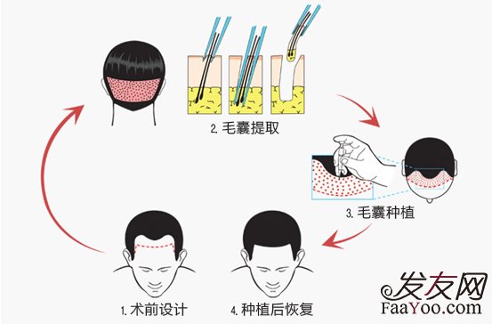 植发技术你都了解多少？　