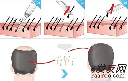 王宇讲解:植发是怎么治疗脱发的?