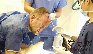 王宇讲解:植发到底怎么样你们知道吗?