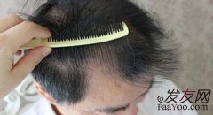 6大原因导致发际线高，头发稀少！8种对策完美解决你的脱发难题！！