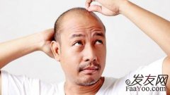 有什么方法能够治疗脱发