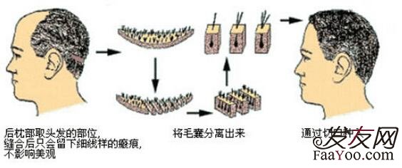 植发手术，头发稀疏