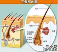 脂溢性脱发，植发后还会出油吗？