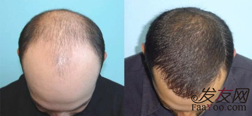 植发手术前后图片对比