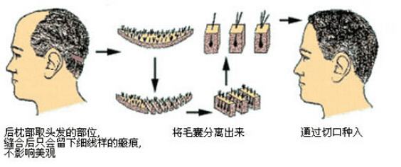 植发手术 提取后枕部资源图