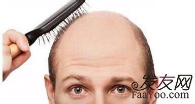 王宇讲解:脱发原因跟调理的方法?