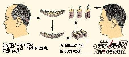 植发手术提取后枕部毛囊