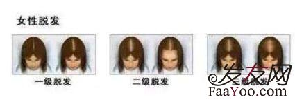 王宇讲解:脱发的种类都有什么?