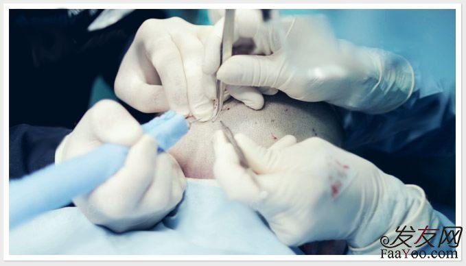 王宇讲解：植发后还用使用药物吗？　