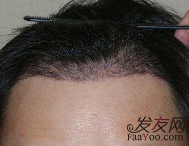 植发效果应该如何来判断？　