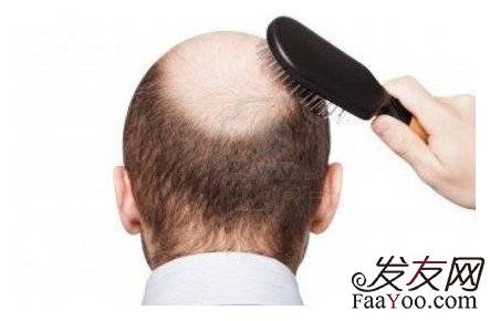 那种脱发不能植发吗？　