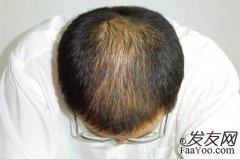 能够治疗脱发的方法有什么？
