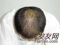 治疗脱发的方法都有那些？