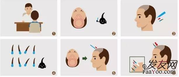 植发是怎么治疗脱发的?