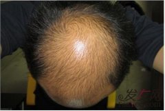 脂溢性脱发是什么原因导致的？