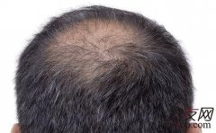 患脂溢性脱发之后还能再长出头发吗？