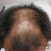 植发会留下后遗症吗？