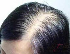 植发时取发区的头发是不是会变少