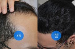为什么那么多人选择植发？植发效果怎么样？