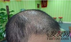在植发时，如何保障毛囊的成活率？