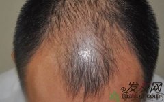 遗传性脱发一般从几岁开始