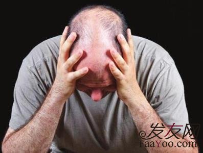 脂溢性脱发的三大误区,你中招了吗