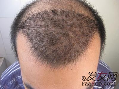 男性脱发:发际线两侧额角怎么生发