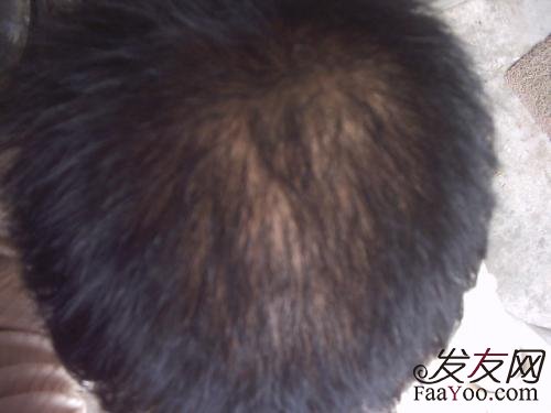 植发后头发生长过程是什么