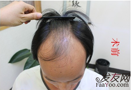 有治疗脂溢性脱发的方法吗?