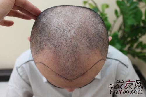 男性脱发是“绝症”吗?