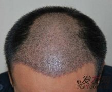 导致脱发的5种因素全包括