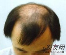 男性脱发有什么危害？应该多注意什么