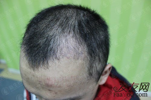植发三个月