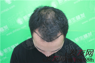植发之前的我