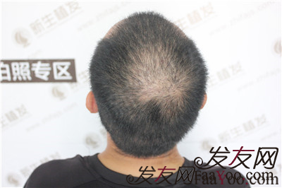 植发一个月