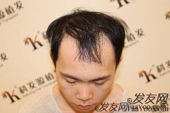 22岁小伙通过植发治疗脂溢性脱发