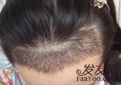 植发，帮我造就完美发际线