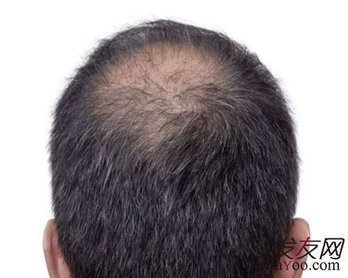 增发纤维能沾头皮吗