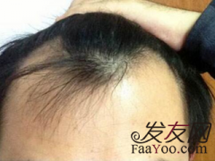 没有别的途径，最终还是选择植发