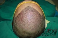 人生短短的几十年，植发让我活得精彩