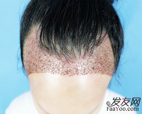 植发效果多久有效果