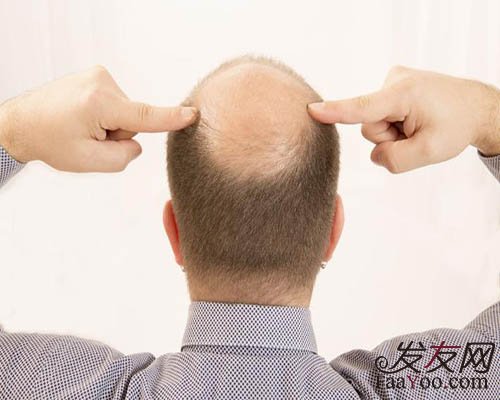 增发纤维会影响毛囊吗