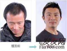 植发，让我找回年轻