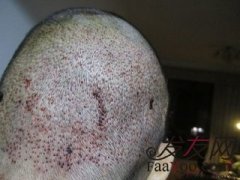 重拾正常生活，重拾自信