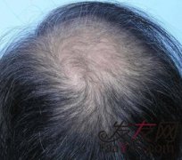 保护好头发，保护我们的自信