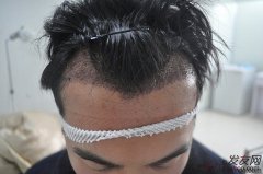 到头来，还是走上了植发这条路