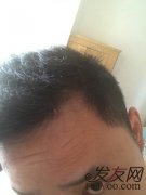 找回头发，完成心愿