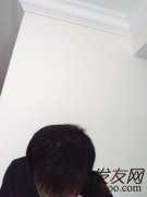 脱发使我变得走在外面都不敢抬头挺胸