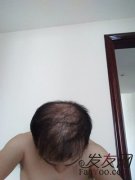 脱发的我，越愁头发越掉