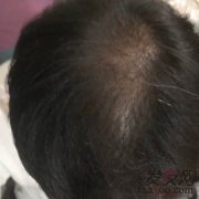 因为年轻没有重视，导致头发越来越少